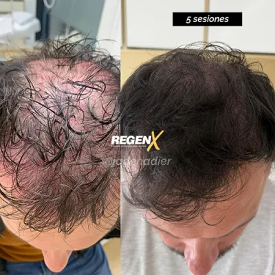Comparaison avant/après publiée par la marque RegenX, vue de face du cuir chevelu.