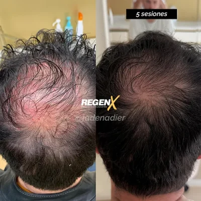 Autre angle du même exemple RegenX : comparaison avant/après du sommet du crâne.