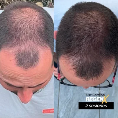 Comparaison avant/après publiée par la marque RegenX, cheveux courts vus de face.