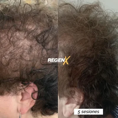 Comparaison avant/après publiée par la marque RegenX, chevelure vue de profil.