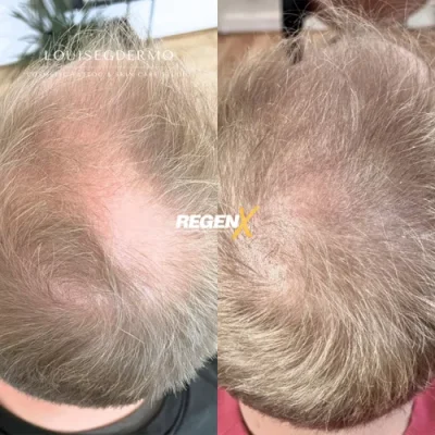 Comparaison avant/après publiée par la marque RegenX, chevelure claire vue du dessus.