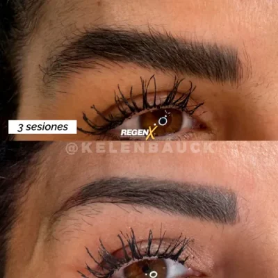 Comparaison de sourcils publiée par la marque RegenX, deux vues rapprochées superposées.