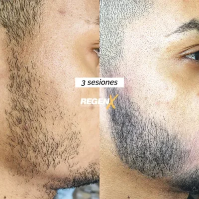 Comparaison avant/après de barbe publiée par la marque RegenX, deux vues de profil côte à côte.