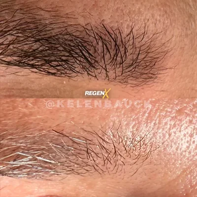 Comparaison de sourcils publiée par la marque RegenX, détail des poils en deux vues superposées.