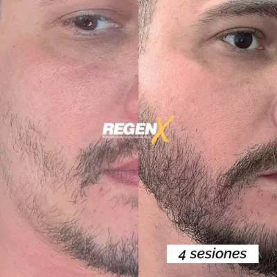 Comparaison avant/après de barbe publiée par la marque RegenX, deux vues de la joue et du menton.