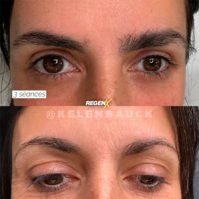 Comparaison de sourcils publiée par la marque RegenX, vues du regard disposées verticalement.