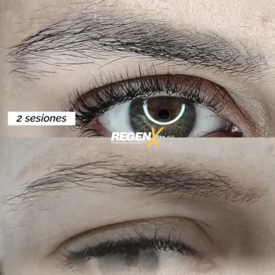 Comparaison de sourcils publiée par la marque RegenX, gros plans du sourcil et de l’œil.