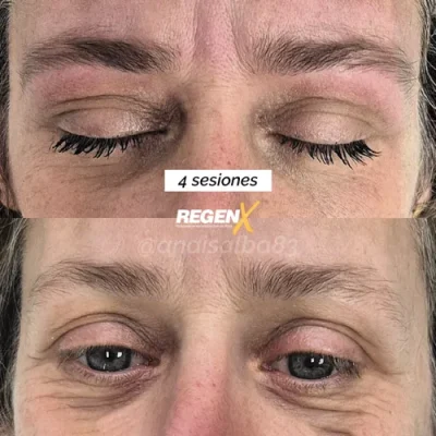 Comparaison de sourcils publiée par la marque RegenX, deux photographies du regard superposées.